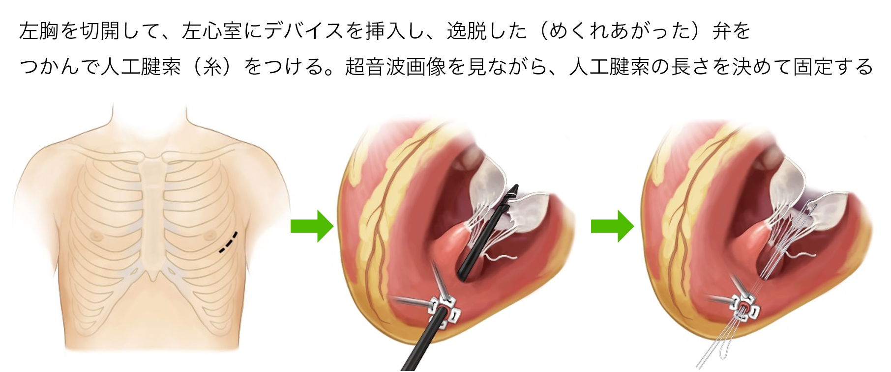 Neochordデバイスよる治療のイメージ