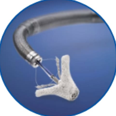 MitraClipで留置する人工弁